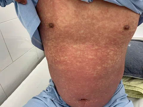 Cảnh báo: Không mua thuốc chống viêm Phenylbutazone bị cấm tại Việt Nam